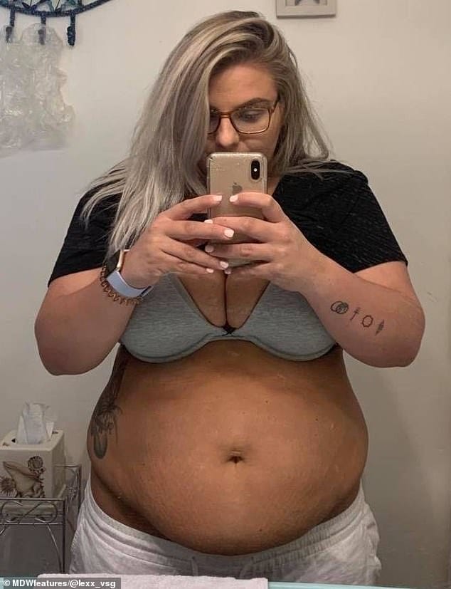 Struggles: Before her weight loss surgery, Alexis was eating 2,500 calories a day, and at her heaviest, she weighed 226lbs