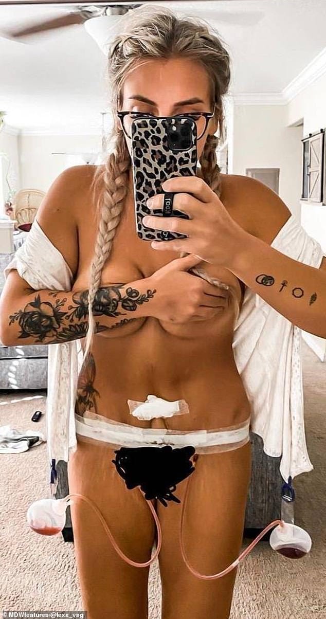 Procedure: After the birth of her third child, Alexis was advised by her doctors to undergo a vertical sleeve gastrectomy, which restricted her food intake and helped her to lose 100lbs