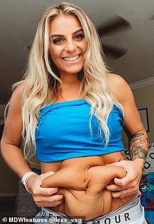 New lease on life: Prior to her weight loss and excess skin surgeries, Alexis' diet consisted of pizza, burgers, McDonald's, soda, and sugary cereals, but she has now given those all up