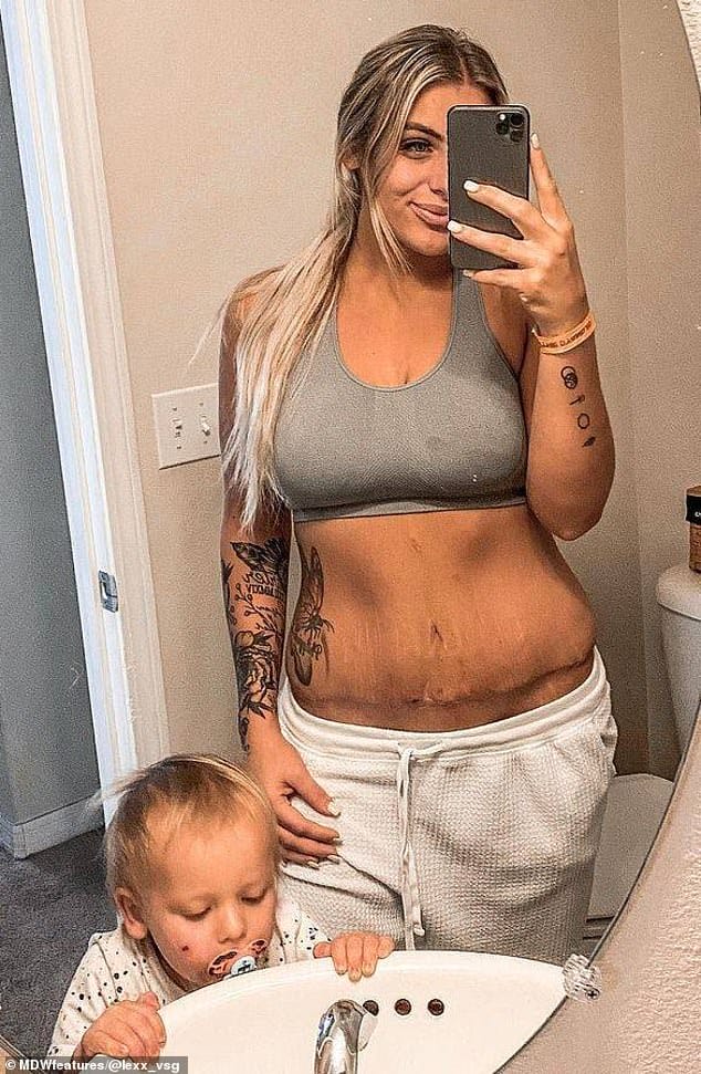 After: Alexis attempted multiple fad diets but was unable to stick to any of them for longer than a week, so she decided to kick loss her weight journey by undergoing surgery