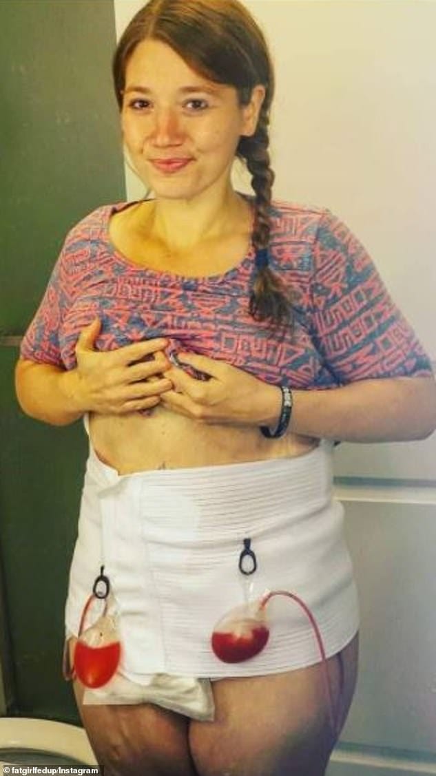 In 2018, she underwent a nine-hour surgery to remove seven pounds of excess skin from her body with the intention of having more removed in the future