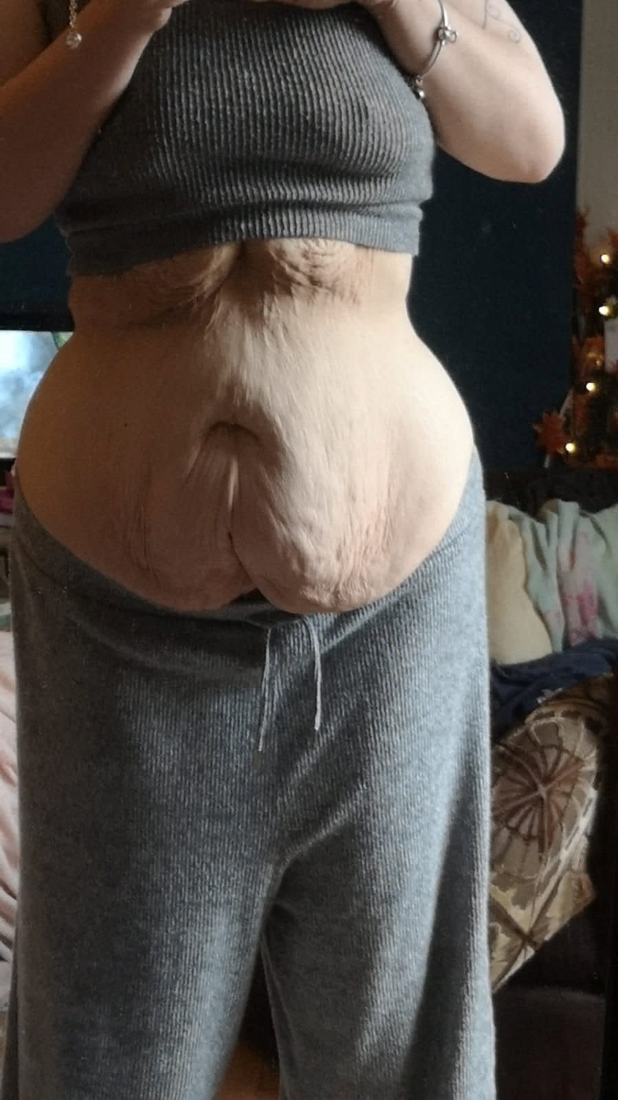 Clara Barrett's weight loss has left her with excess skin she wants to have removed. (SWNS)